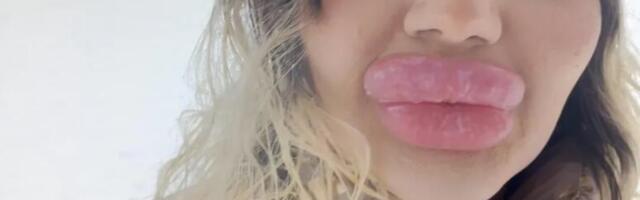 Andrea ima najveće usne na svetu: Zbog njih ima problem sa disanjem, stomatolozi odbijaju da joj leče zube, ali ona ne planira da se zaustavi!