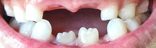 Prvi lek na svetu koji može obnoviti zube odobren za ljudska ispitivanja