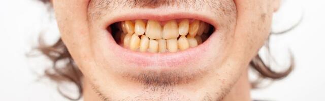 Zubar otkrio šest svakodnevnih grešaka zbog kojih zubi žute – a većina ih pravi svaki dan