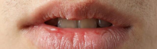 Pojavile su vam se bele tačkice na usnama ili intimnim delovima? Evo šta to zaista znači