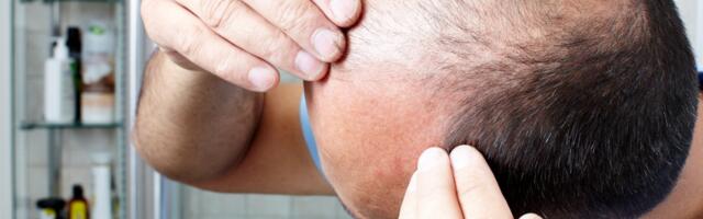 Mislite da je genetika, a kriva je uobičajena navika: Ova svakodnevna rutina ubrzava ćelavost i sedenje kose