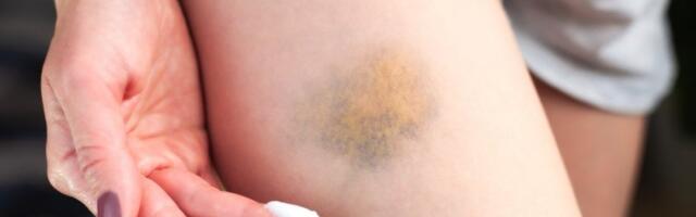 Briše modrice kao gumicom: Maska od ove biljke je prirodno čudo, a lako se pravi