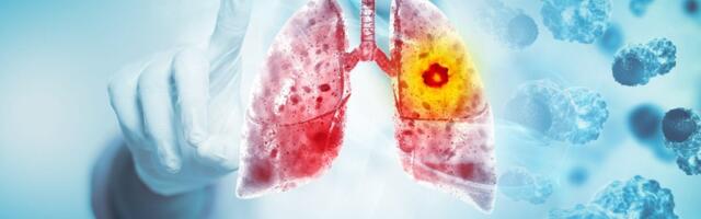 Rak pluća i bronha ubedljivo najsmrtonosniji: U Srbiji najviše umiru žene, a ovi podaci će vas šokirati