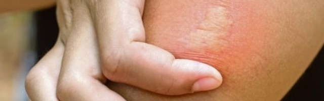 Šta je najbolje uraditi ako vas ujede osa