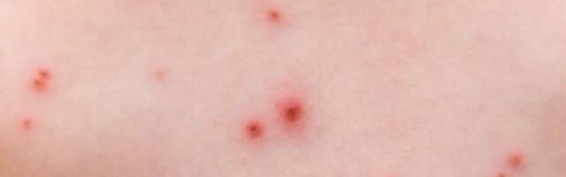 U Beogradu 41 slučaj malih boginja