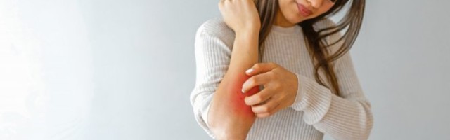 SVE ŠTO TREBA DA ZNATE O PSORIJAZI! Stručnjaci su otkrili UZROK, a zbog OVOGA se stanje može pogoršati!