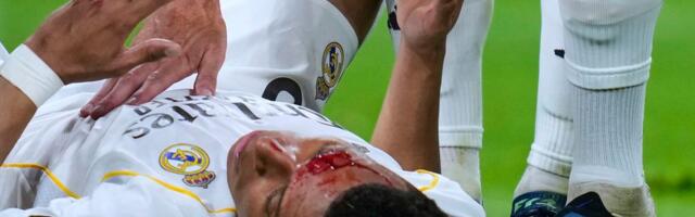 Jeziva povreda, kao da ga je pogodila raketa: Mbape objavio fotografiju posekotine na glavi! /FOTO/