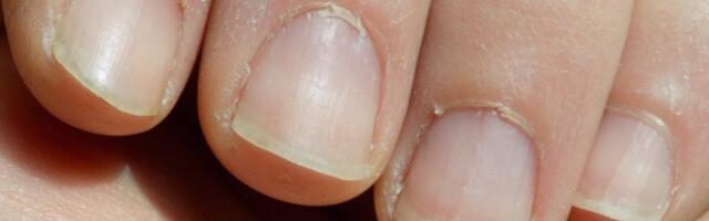 Ovaj znak ukazuje na rak: Promene na noktima otkrivaju od čega bolujete