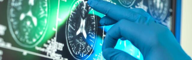 'Inovativni' lekovi protiv Alchajmera ne pomažu značajno: analiza