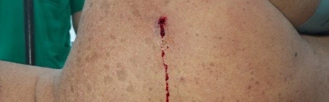 INFORMER.RS EKSKLUZIVNO! Pogledajte ranu od šiptarskog metka na leđima ranjenog Srbina u Zvečanu! /uznemirujući foto/