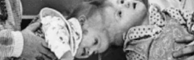 Rođene su sa spojenim glavama, a onda je 20 sati na operacionom stolu odredilo njihovu sudbinu