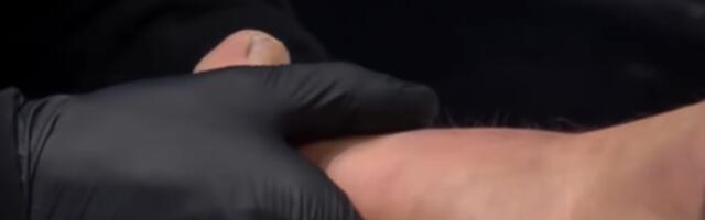 Nije za one sa slabim stomakom: Miloš Cvjetićanin slomio prst usred borbe, doktor mu ga odmah namestio /VIDEO/