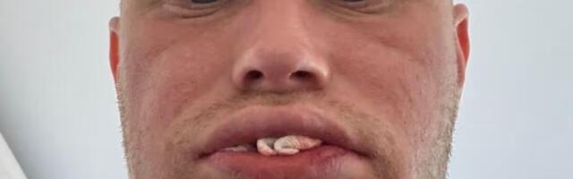 Otišao sam u Tursku da jeftino sredim zube, a sad nemam nijedan: Kad se probudio iz anestezije ostao je sleđen