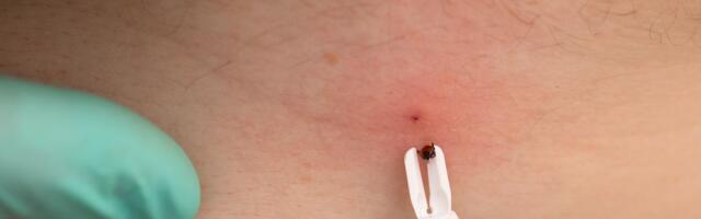 Pospite krpelja ovim sastojkom i sačekajte 20 minuta - tvrde da se sam izvlači