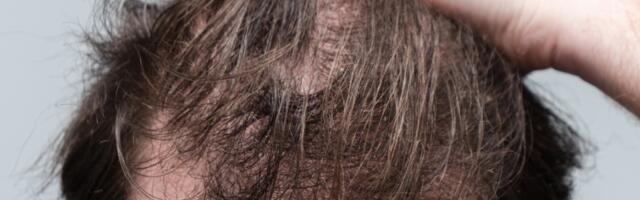 Kako da proređenu kosu učinite gušćom