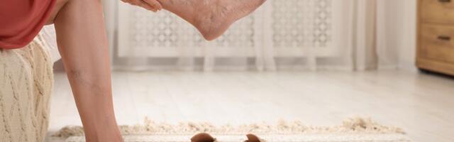 Da li nedostatak vitamina uzrokuje nastanak proširenih vena? Doktor daje detaljan odgovor