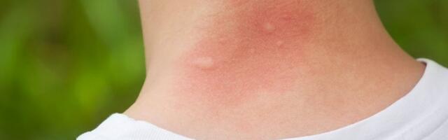 DOMOVI ZDRAVLJA PUNI LJUDI: Najezda opasnih insekata u Srbiji uzima danak