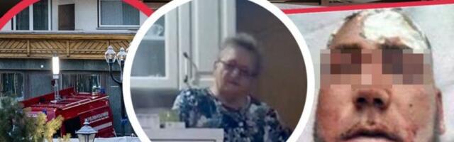 LICE MU SKROZ SPALJENO! Potresne slike Srbina koji je bio u baru smrti u Švajcarskoj, baka Dobrila u suzama: Bolje da crknem, nego...