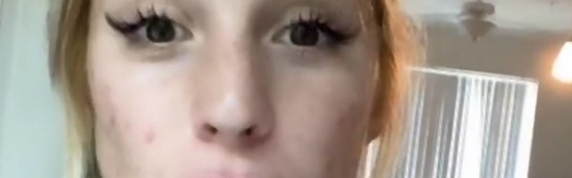 TikTokeri stavljaju krompir na lice jer misle da će im to izlečiti bubuljice - dermatolozi u šoku