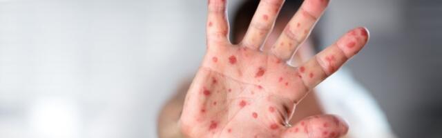 Prijavljena epidemija malih boginja u Beogradu