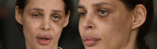 UZNEMIRUJUĆA FOTOGRAFIJA NATAŠE ŠAVIJE: Starleta u suzama, modricima i podlivima ne može da dođe sebi (FOTO)