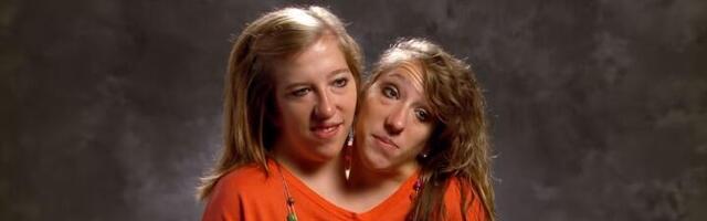 Dve glave, jedno telo: Život sijamskih bliznakinja (32) (VIDEO)