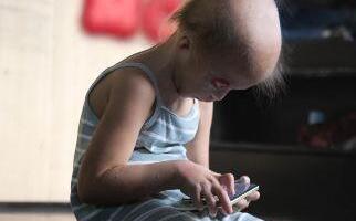 Aleksandra je rođena bez kapaka i spava otvorenih očiju: Otac je ostavio čim je ugledao, majka krpi kraj s krajem