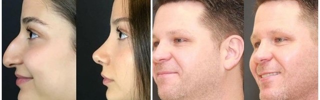 Pre i posle: Ovo su neke od najuspešnijih plastičnih operacija (FOTO)