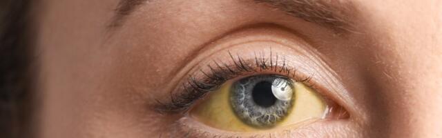 Visok holesterol često prolazi neprimećeno – ovo su 3 suptilna znaka upozorenja