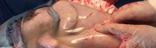Trojke rođene sa sve vodenjakom: Jedna spava, doktori ne veruju  (VIDEO)