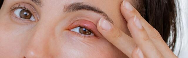 Ako vam je izašao čmičak, ovo ODMAH stavite na oko: Svi je imaju u dvorištu i najbolji je prirodni lek