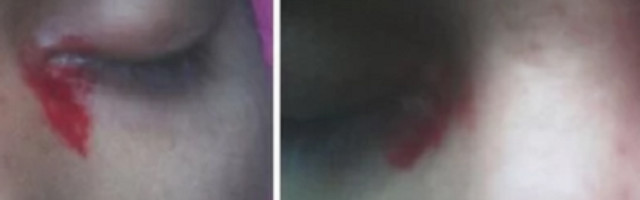 Devojka zaprepastila lekare i naučnike kada su joj na oči pošle ČUDNE SUZE (FOTO)