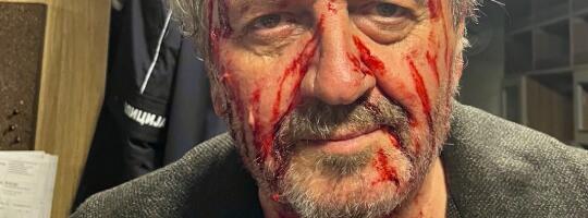 RADOŠ BAJIĆ SAV KRVAV - Glumac šokirao fotografijom: "Ginuo sam bezbroj puta, bio ranjavan"