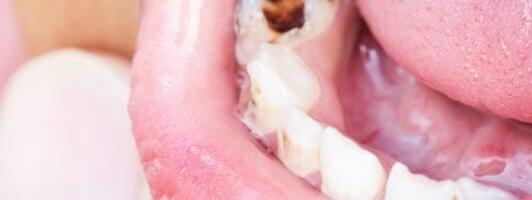 Opasna "tiha bolest" prvo se ispolji u ustima: Zašto treba otići kod zubara i kada vas zub ne boli