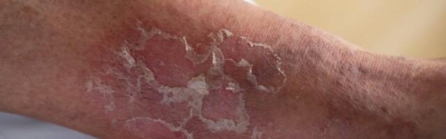 Puca vam koža i opada kosa? Ne zanemarujte ove simptome - evo na šta ukazuju