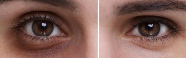 Zaboravite na podočnjake: Trik koji ih briše preko noći - dermatolozi oduševljeni