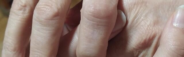 Udruženje pacijenata: Oboleli od psorijaze da preuzmu aktivnu ulogu u svom lečenju, posebno u Leskovcu