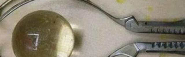 Žalio se da ne može da ide u wc, kad su ga stavili na magnet, doktori su zanemeli od šoka - JEZIVO ŠTA JE STAVIO!