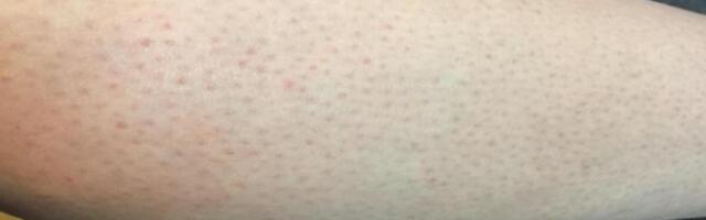 IMATE LI CRVENE TAČKICE NA NOGAMA KAO JAGODE? ŽENE, OBRATITE PAŽNJU, kada čujete 4. razlog, sve će vam biti jasno