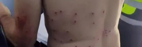 Biciklista napunjen sačkom nakon što ga je jedan lovac zamenio za zeca