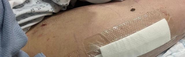 Sportista podelio jezive fotke iz bolnice: Izliv krvi u mozak, probušeno plućno krilo i smrskana noga...