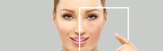 Na prirodan način uklonite tamnu kožu oko usana