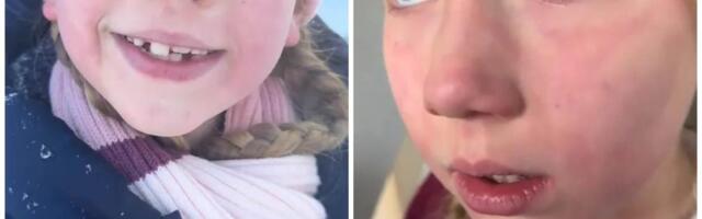 "Sneg može dovesti moju ćerku u kritično stanje" Zbog alergije za koju je retko ko čuo dete prolazi pakao, simptomi su jezivi FOTO