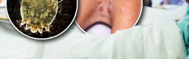 SRPSKI PROFESOR UPOZORAVA! Šuga je bolest od koje se leče svi članovi jednog domaćinstva - EVO KAKO SE ŠIRI ZARAZA