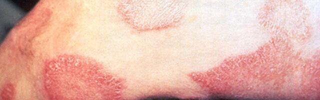 Stručnjaci za Danas o lepri: Kako se pojavljuje, ko je pod rizikom i kako se leči?