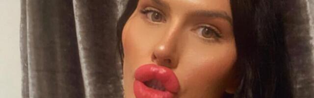 IMA NAJVEĆE USNE NA SVETU I NE PLANIRA DA SE ZAUSTAVI: Nikada nije imala granicu - evo kako je izgledala pre intervencije! (FOTO)