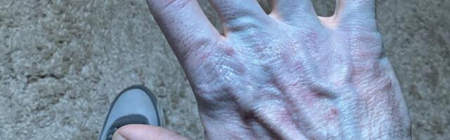 Čovek se probudio plav od glave do pete i hitno završio u bolnici: Koža mu izgleda kao da je upao u farbu!