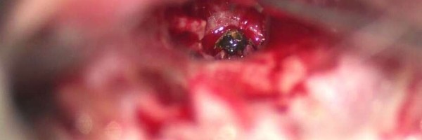 Varioc umalo trajno ostao bez sluha zbog otopljenog metala