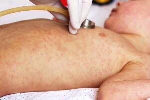 У Србији 39 оболелих од малих богиња, мере појачаног надзора у целој земљи