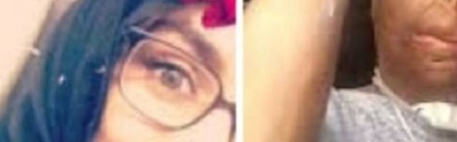 Napravila glupu grešku, bila u komi dva meseca i izgubila sedam prstiju (VIDEO)